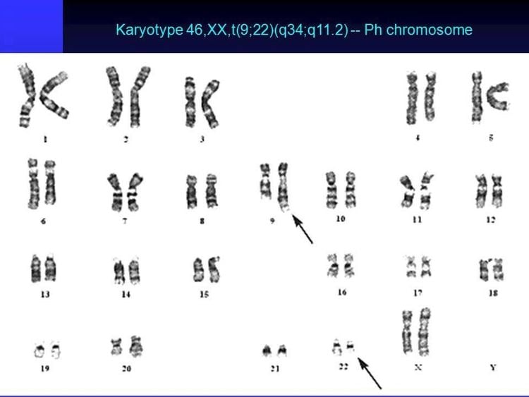 Karyotype bất thường ở nữ giới có chuyển đoạn (9;22) (Leukemia AML ALL FAB classification WHO classification- https://slideplayer.com/)
