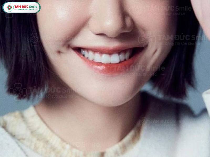 Đồng điếu ở rãnh cười tốt hay xấu? Có ý nghĩa gì?