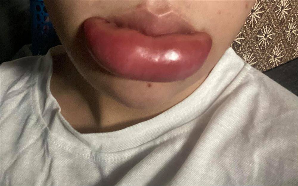 Lần 2 tiêm tan thậm chí không tiến triển mà còn tấy đỏ hơn nữa. Nhìn thôi đã thấy đau!