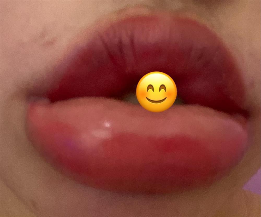 Lần 3 tiêm của cô nàng được luôn combo sưng vều cả môi trên.