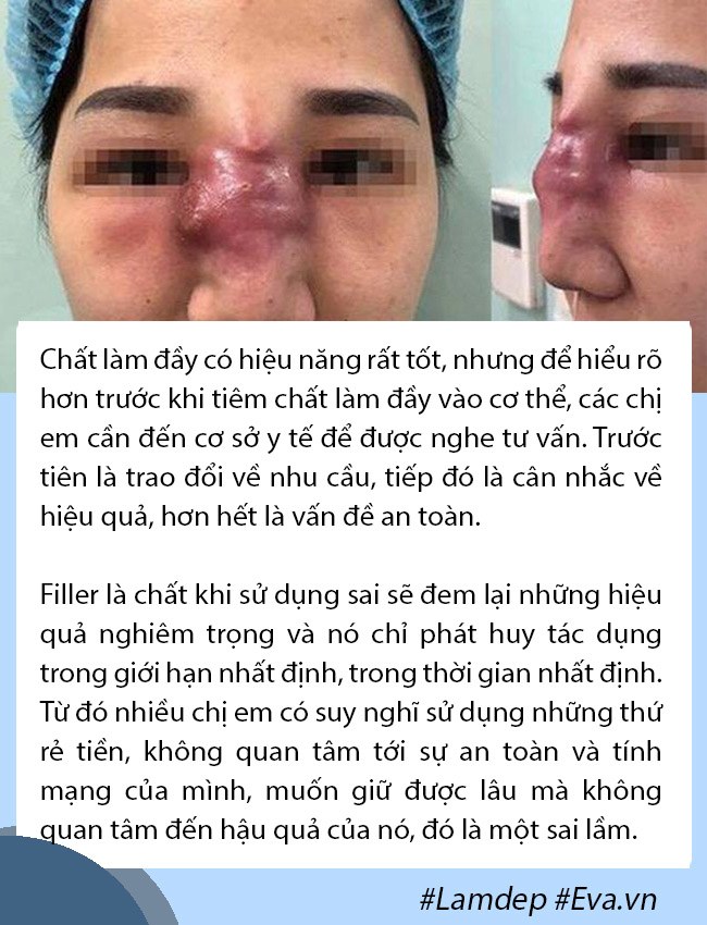 Tâm linh không dám đi cắt môi, gái xinh mạnh dạn tiêm filler nhận ngay đôi môi thảm họa - 9