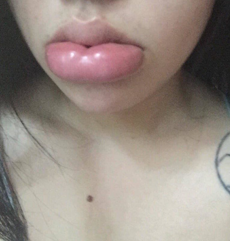 Tâm linh không dám đi cắt môi, gái xinh mạnh dạn tiêm filler nhận ngay đôi môi thảm họa