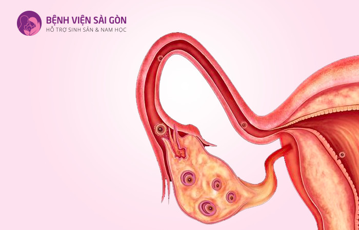 Chất đối kháng hormone GnRH có vai trò quan trọng trong IVF