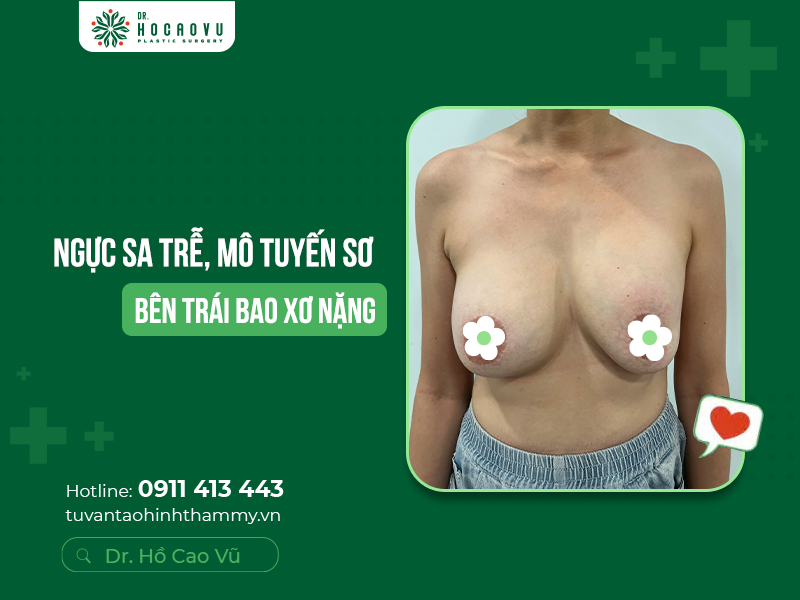 Biến chứng đặt túi ngực to: Nguyên nhân, dấu hiệu và giải pháp tối ưu