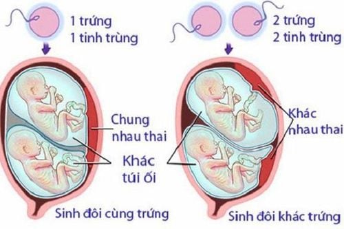 Sinh đôi khác trứng sẽ có hai nhau thai riêng biệt cho hai thai nhi
