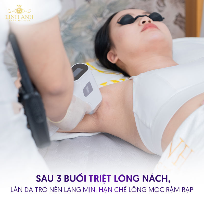 bảng giá triệt lông tại TMV Linh Anh