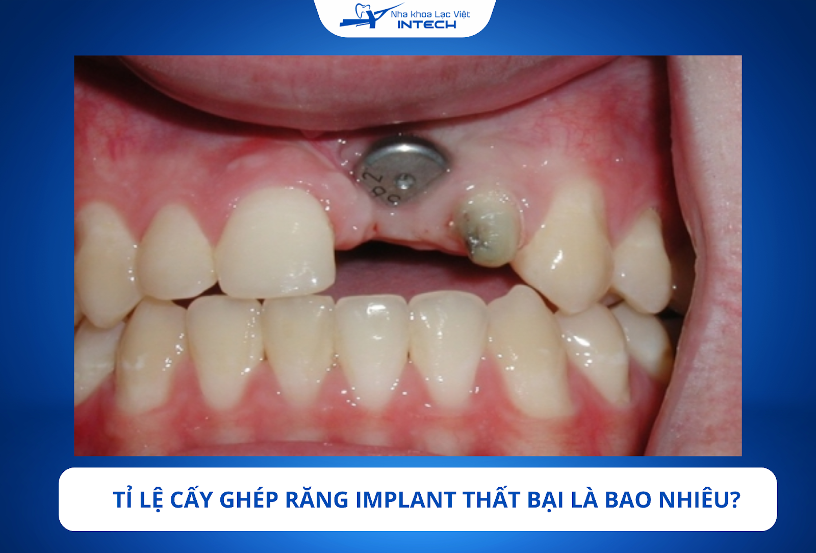 Cấy ghép Implant vẫn có tỉ lệ thất bại nhưng chỉ dao động từ 2 đến 5%