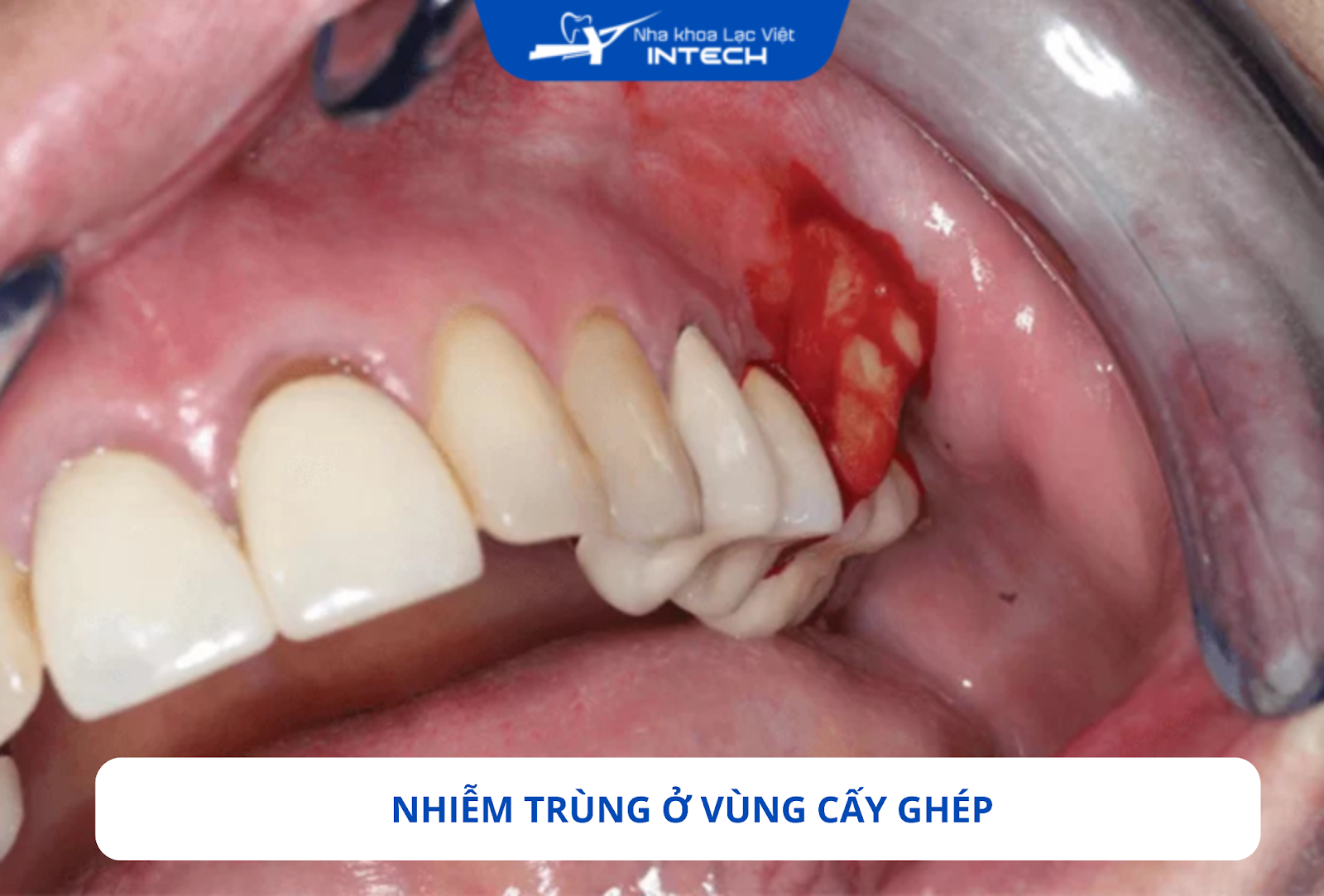 Sau khi cấy ghép, nếu không đảm bảo vệ sinh răng miệng chưa đúng cách, vùng quanh trụ Implant có thể bị nhiễm trùng