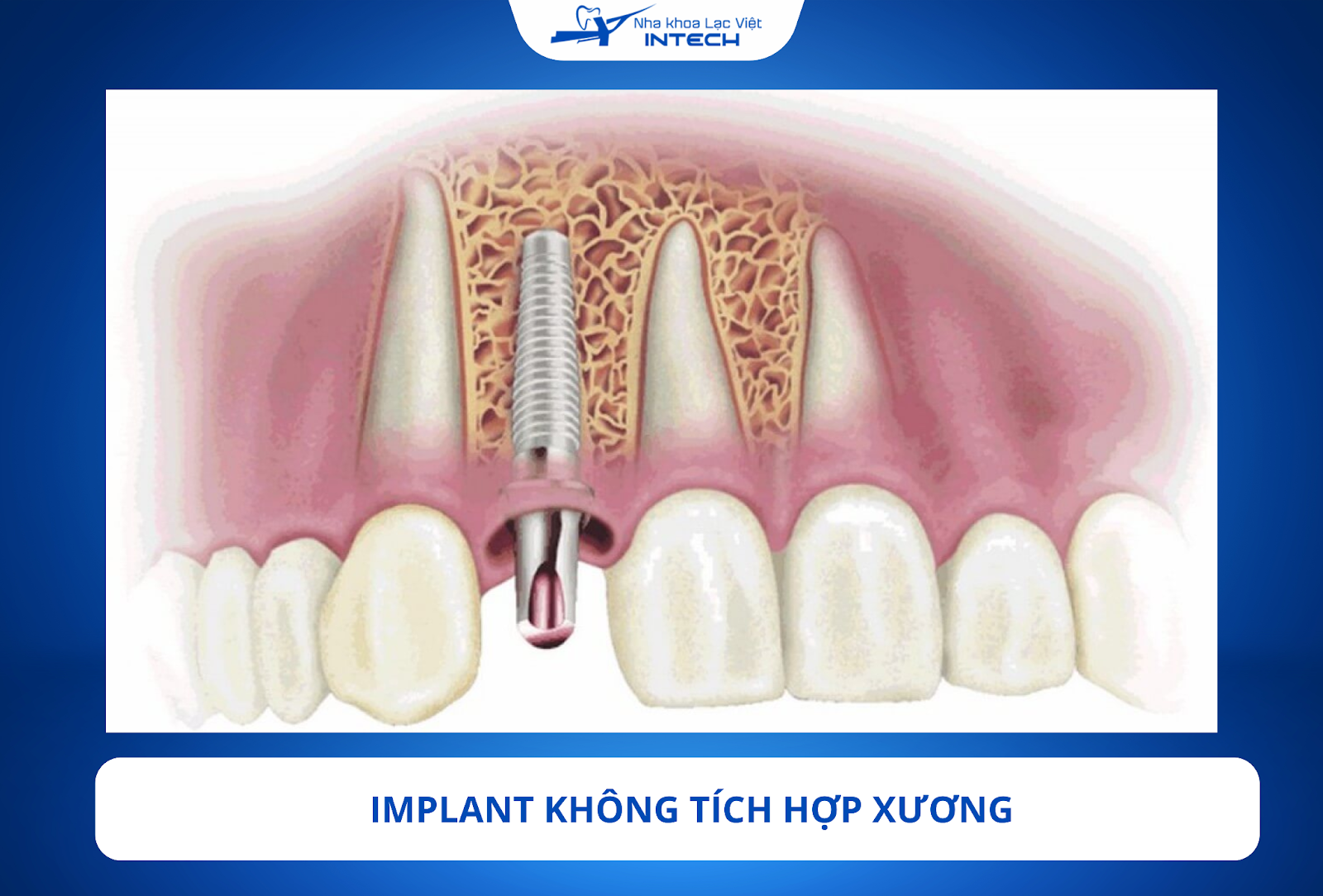 iệc chẩn đoán chính xác và kỹ lưỡng là rất cần thiết để đảm bảo khả năng tích hợp xương tốt nhất cho Implant.