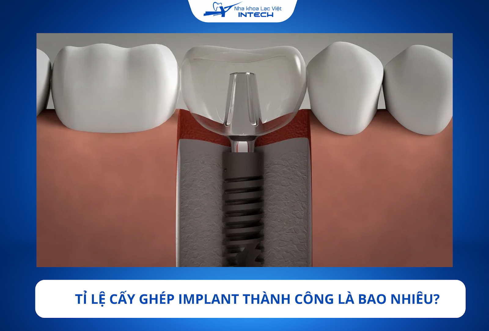 Cấy ghép Implant là phương pháp phục hình răng mất có tỉ lệ thành công cao nhất hiện nay