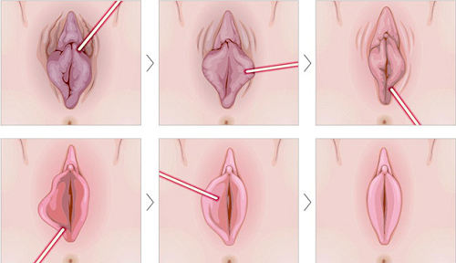 Cắt môi lớn đẹp tự nhiên: Bí quyết tái tạo vùng kín hài hòa và tự tin