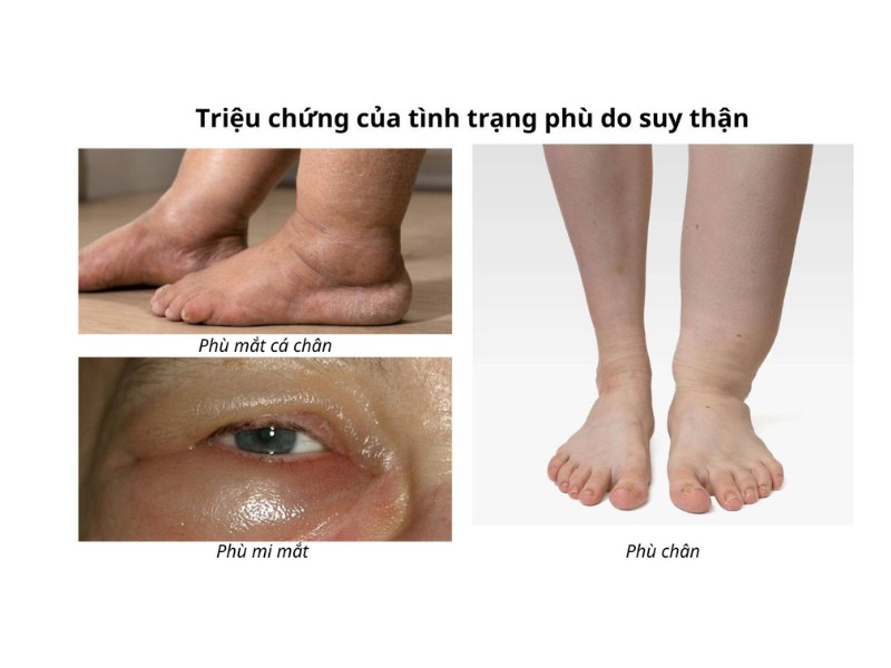 Suy thận có thể dẫn đến tình trạng cơ thể sưng phù