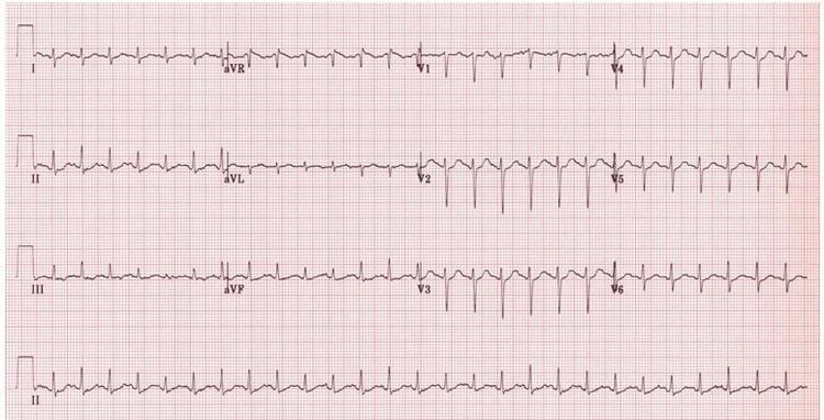 Nhịp xoang nhanh là gì? Điều trị nhịp xoang nhanh như thế nào
