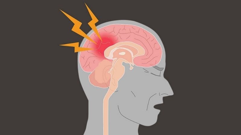 Run có thể do bệnh lý liên quan đến chức năng vận động của não