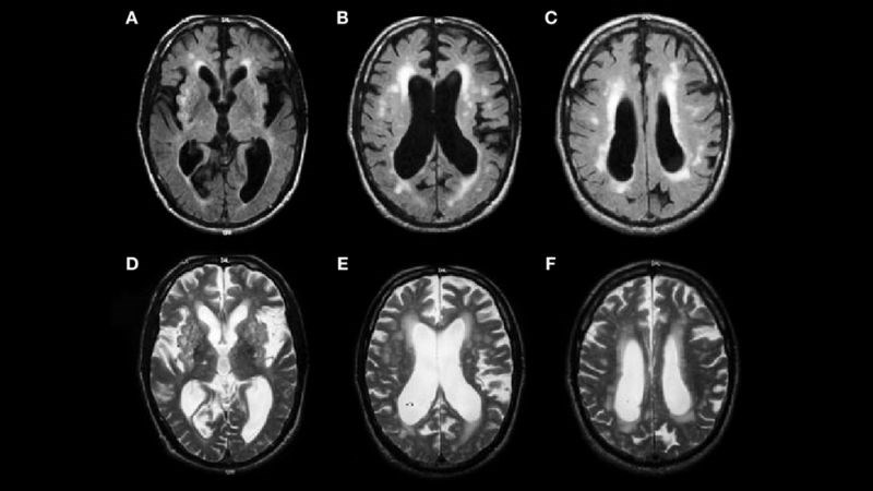 Chụp MRI giúp khảo sát các nguyên nhân gây run tay chân ở não