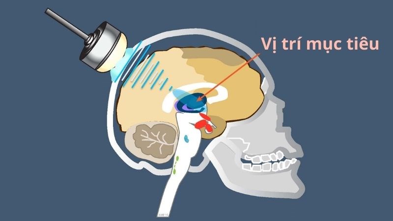 Siêu âm hội tụ cường độ cao giúp loại bỏ vị trí bất thường gây run ở não