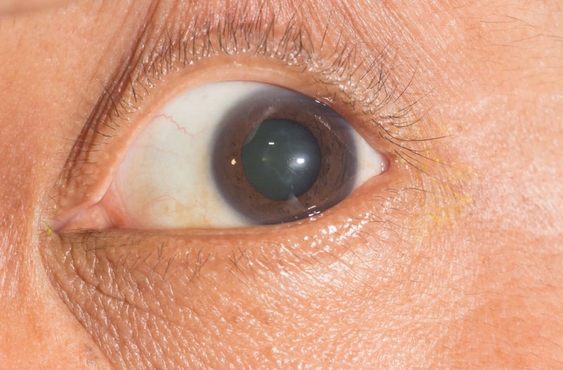 Phản xạ đồng tử là gì? Cơ chế sinh lý và ý nghĩa lâm sàng của phản xạ đồng tử 3