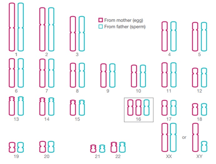 Tam nhiễm sắc thể hiếm