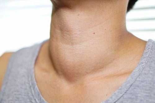 Hình ảnh bệnh cường giáp