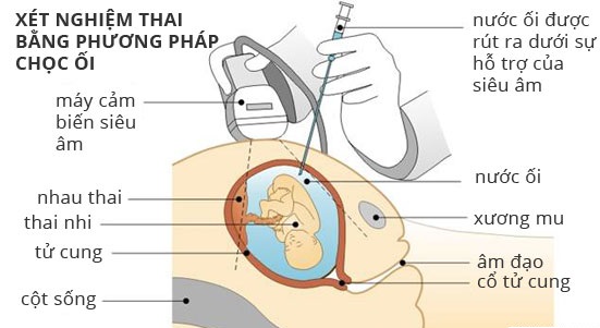 Bảo vệ vốn gen loài người bằng phương pháp sàng lọc trước sinh