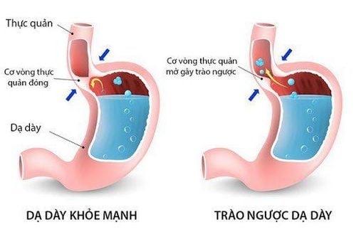 Trào ngược dịch dạ dày vào đường thở là một tai biến sau phẫu thuật