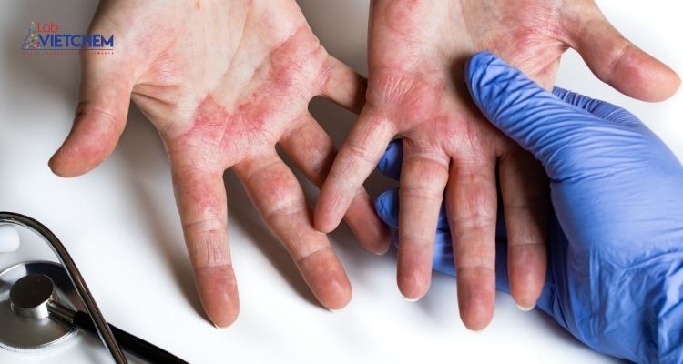 Andehit Propionic có thể gây phồng rộp da