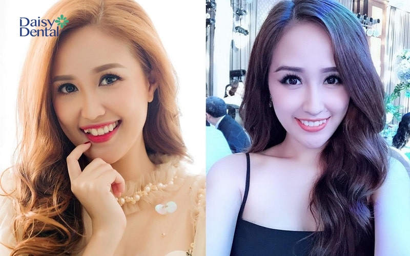 Mai Phương Thúy, Phương Hằng là những người đẹp nổi tiếng trong showbiz có nụ cười răng khểnh