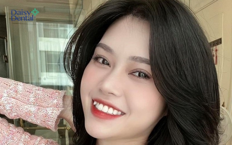 Răng khểnh tuy là răng mọc lệch nhưng mang lại vẻ bất ngờ