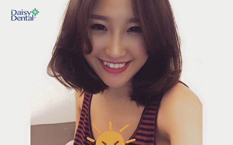 Răng khểnh góp phần làm thăng hạng nụ cười và nhan sắc