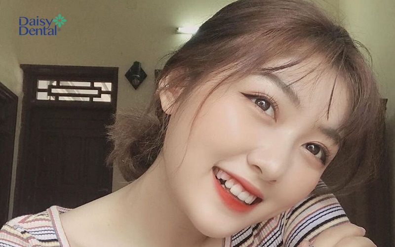 Nhan sắc thăng hạng nhờ chiếc răng khểnh nhỏ xinh