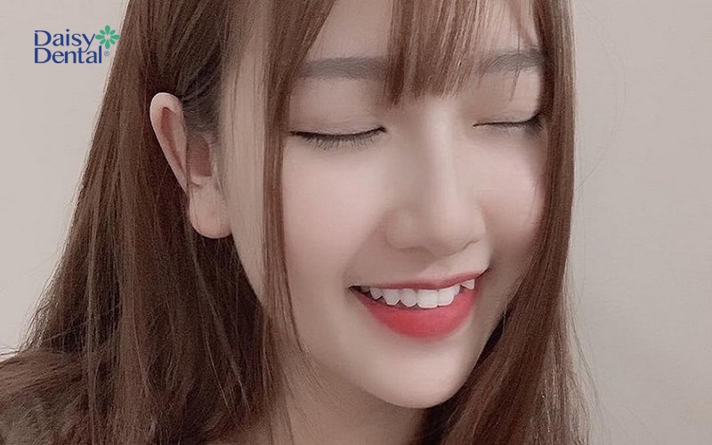 Nụ cười răng khểnh trẻ trung, tươi tắn