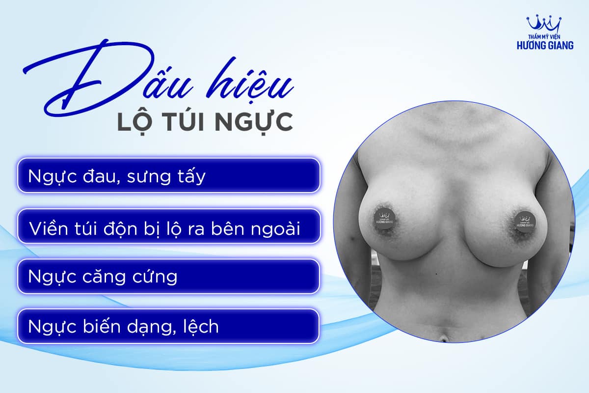 Sửa ngực hỏng vì lộ túi sau phẫu thuật nâng ngực
