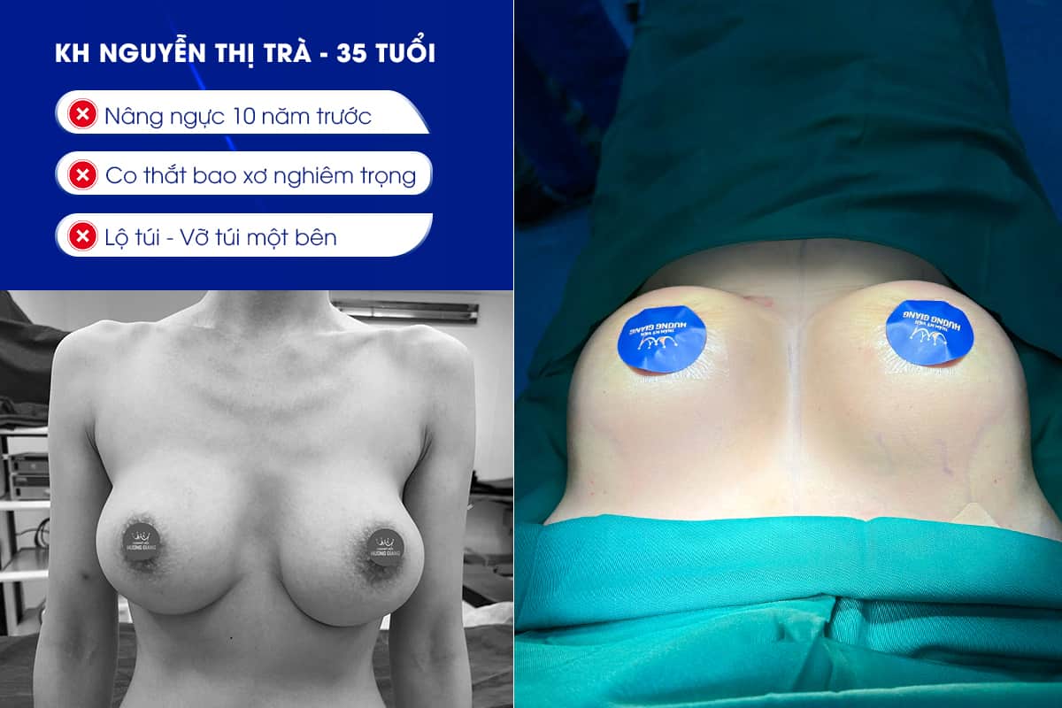 Sửa ngực hỏng vì lộ túi sau phẫu thuật nâng ngực