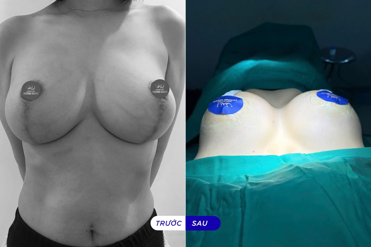 Sửa ngực hỏng vì lộ túi sau phẫu thuật nâng ngực