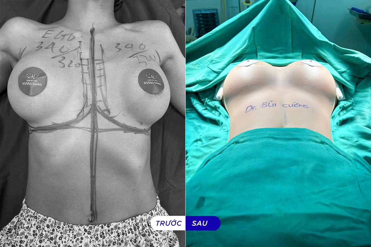 Sửa ngực hỏng vì lộ túi sau phẫu thuật nâng ngực