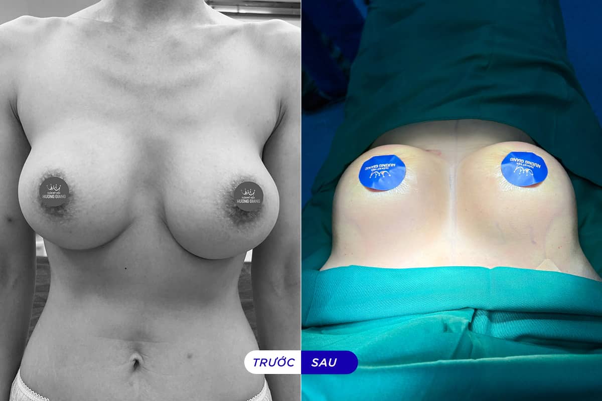 Sửa ngực hỏng vì lộ túi sau phẫu thuật nâng ngực