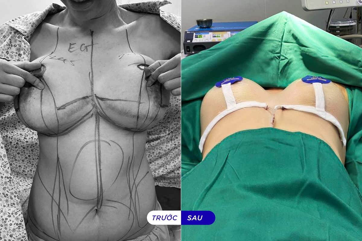 Sửa ngực hỏng vì lộ túi sau phẫu thuật nâng ngực