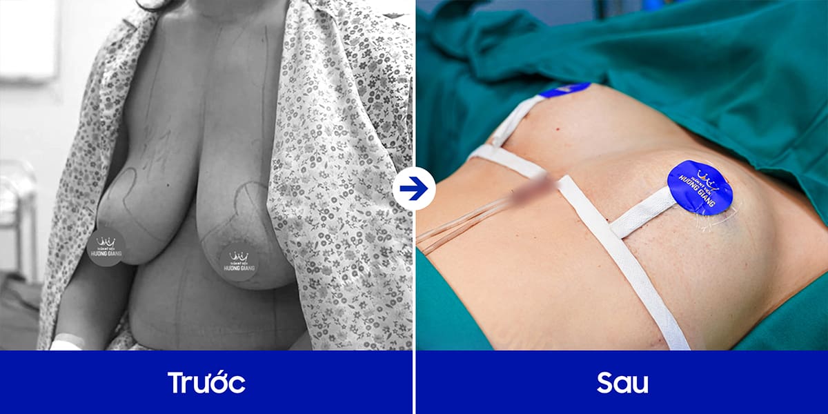 Nỗi ám ảnh ngực phì đại ở nữ giới!