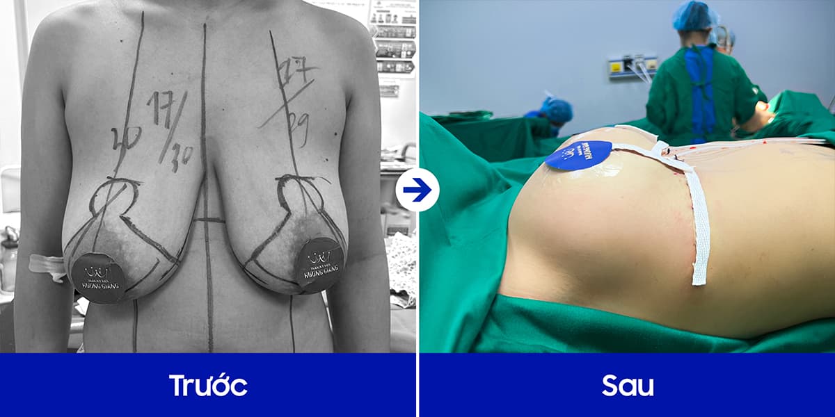 Nỗi ám ảnh ngực phì đại ở nữ giới!