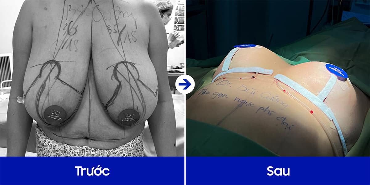 Nỗi ám ảnh ngực phì đại ở nữ giới!