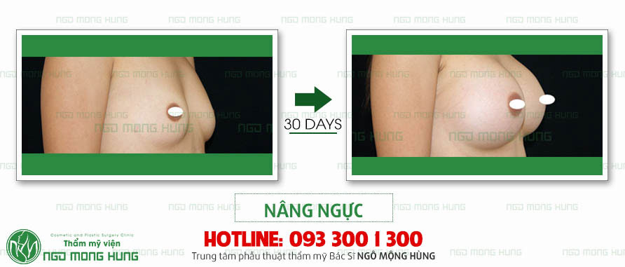 Ảnh ngực hình giọt nước