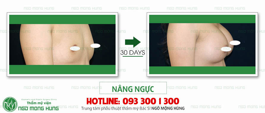 Ảnh ngực hình giọt nước