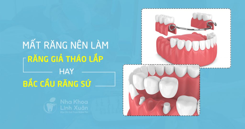 Nên làm răng giả tháo lắp hay bắc cầu răng sứ