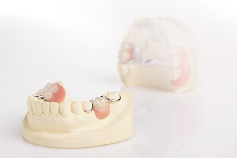 Nên làm răng giả tháo lắp hay bắc cầu răng sứ?