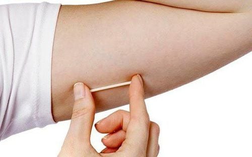 Tránh thai bằng phương pháp que cấy tránh thai
