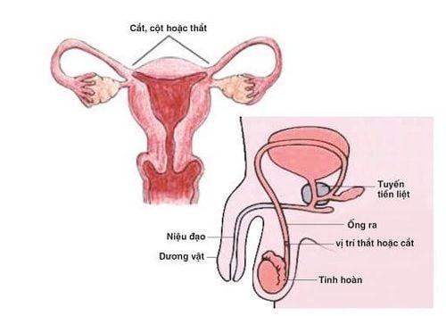 Phương pháp triệt sản nữ ( bên trái) và triệt sản nam (bên phải)