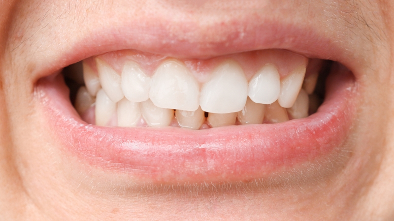 Khuôn mặt bị lệch khi chụp ảnh: Nguyên nhân và cách khắc phục