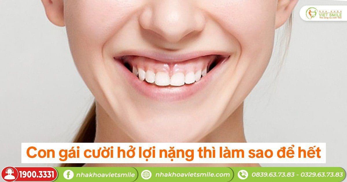 Con gái cười hở lợi nặng thì làm sao để hết