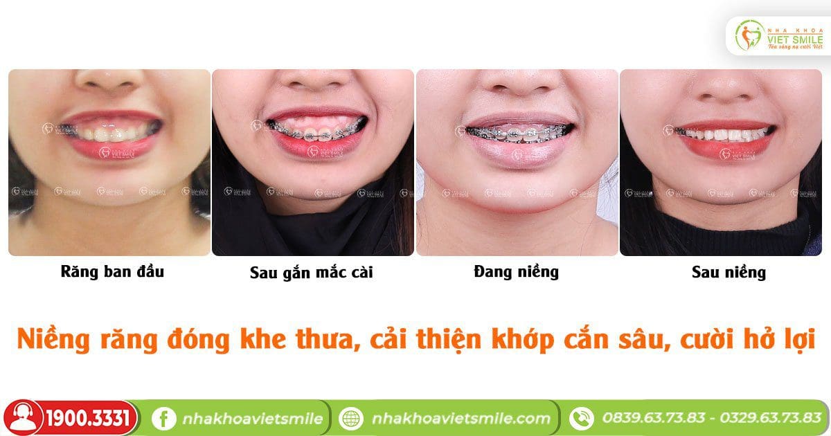 Niềng răng giảm hô, thưa, khớp cắn sâu, điều trị cười hở lợi