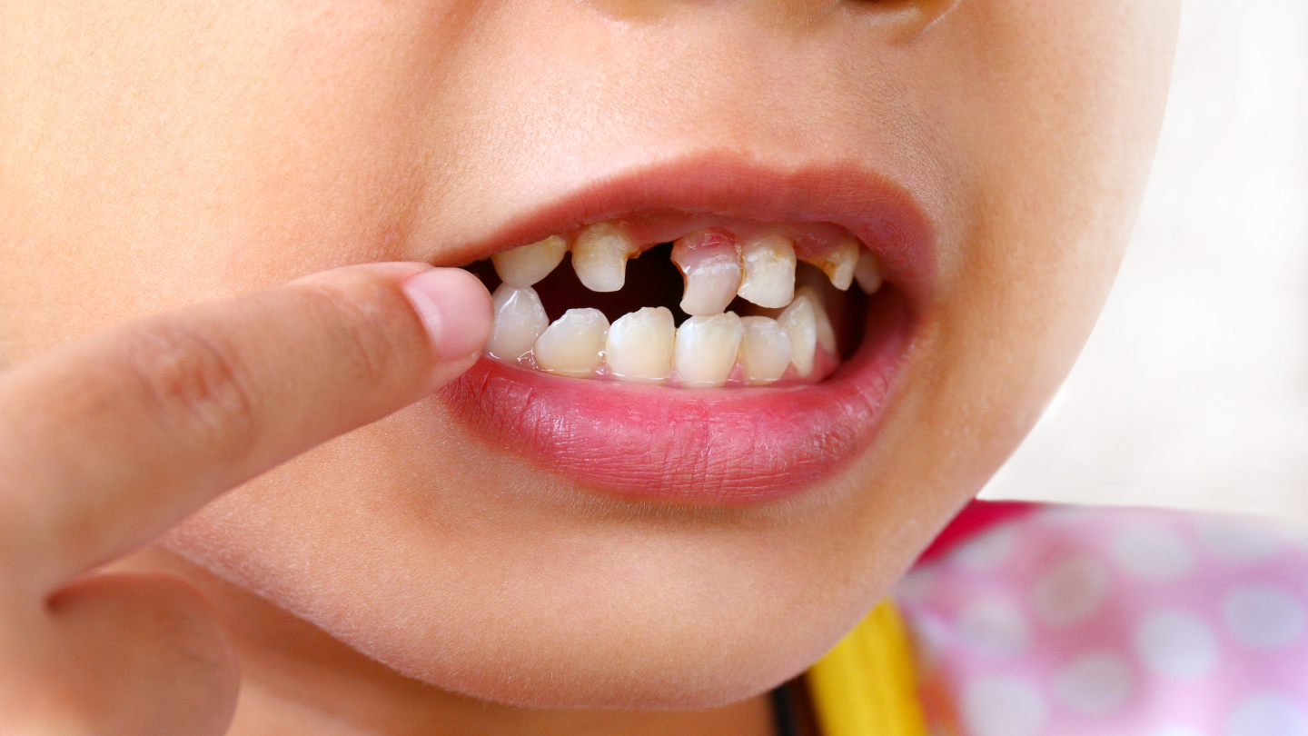 Hình ảnh trẻ không bị dính thắng lưỡi và dấu hiệu trẻ bị dính thắng lưỡi 3